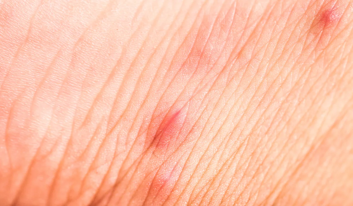 flea bite